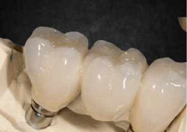 Zirconia Crowns & Bridges