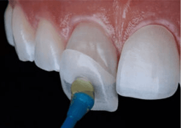 E-max Veneers & Inlays