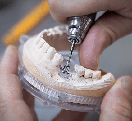 PFM & Metal Restorations