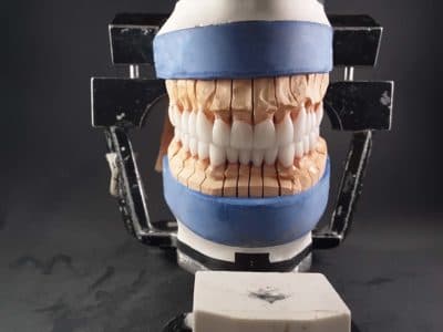 PFM & Metal Restorations